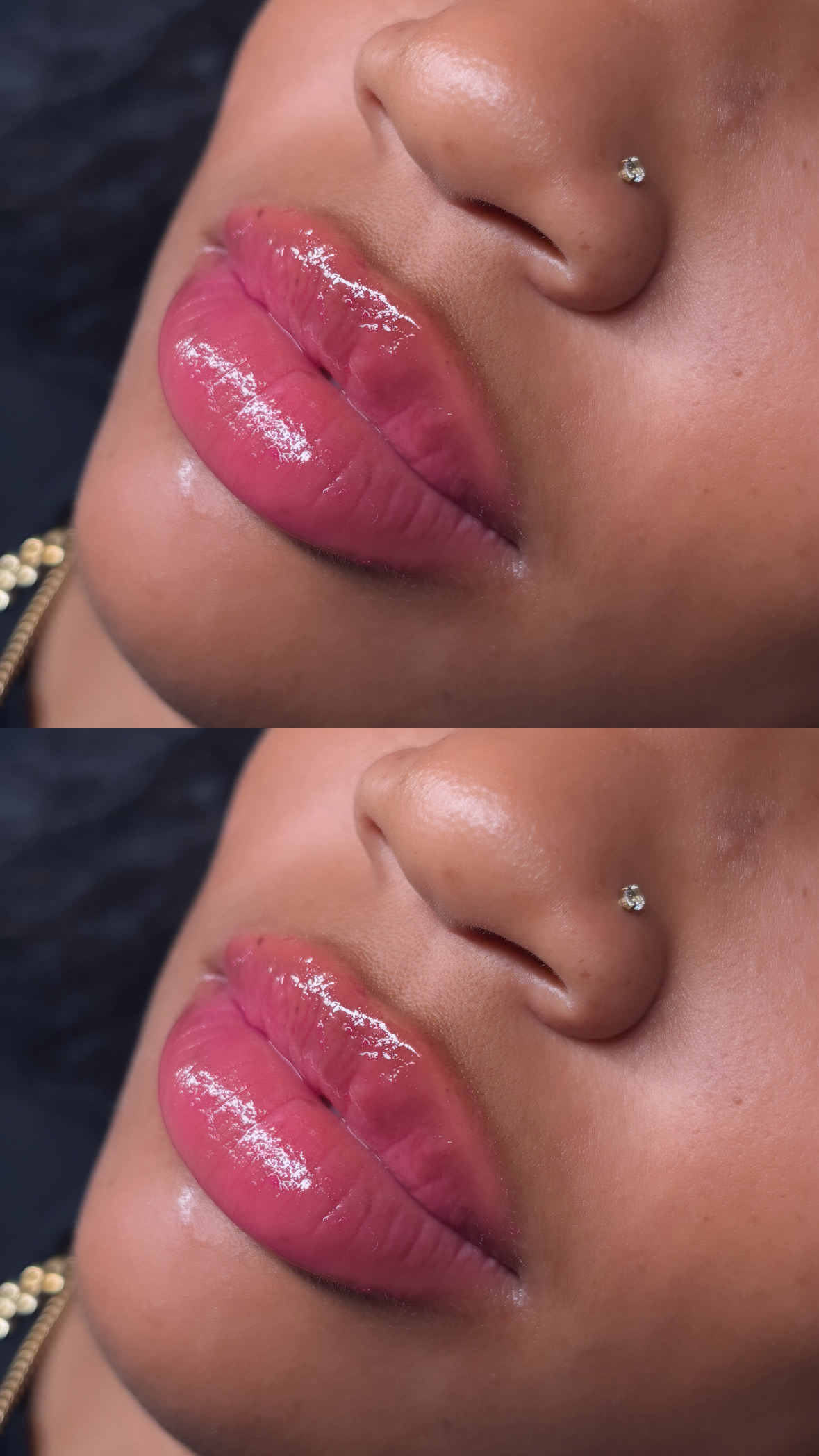 Lip Enhancement — Hers & Her Beauty Bar